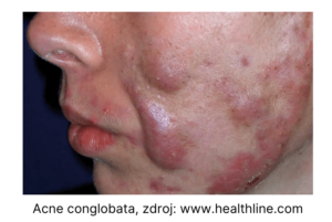 Acne conglobata