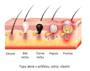 Akné útvary průřez