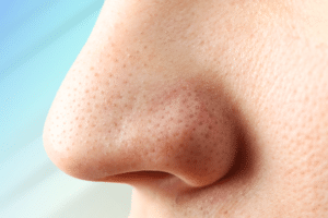 Sebaceous filaments