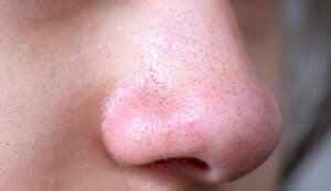 Sebaceous filaments