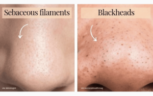 Sebaceous filaments vs černé tečky