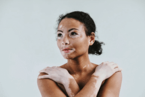 Vitiligo