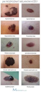 Jak poznat melanom kůže