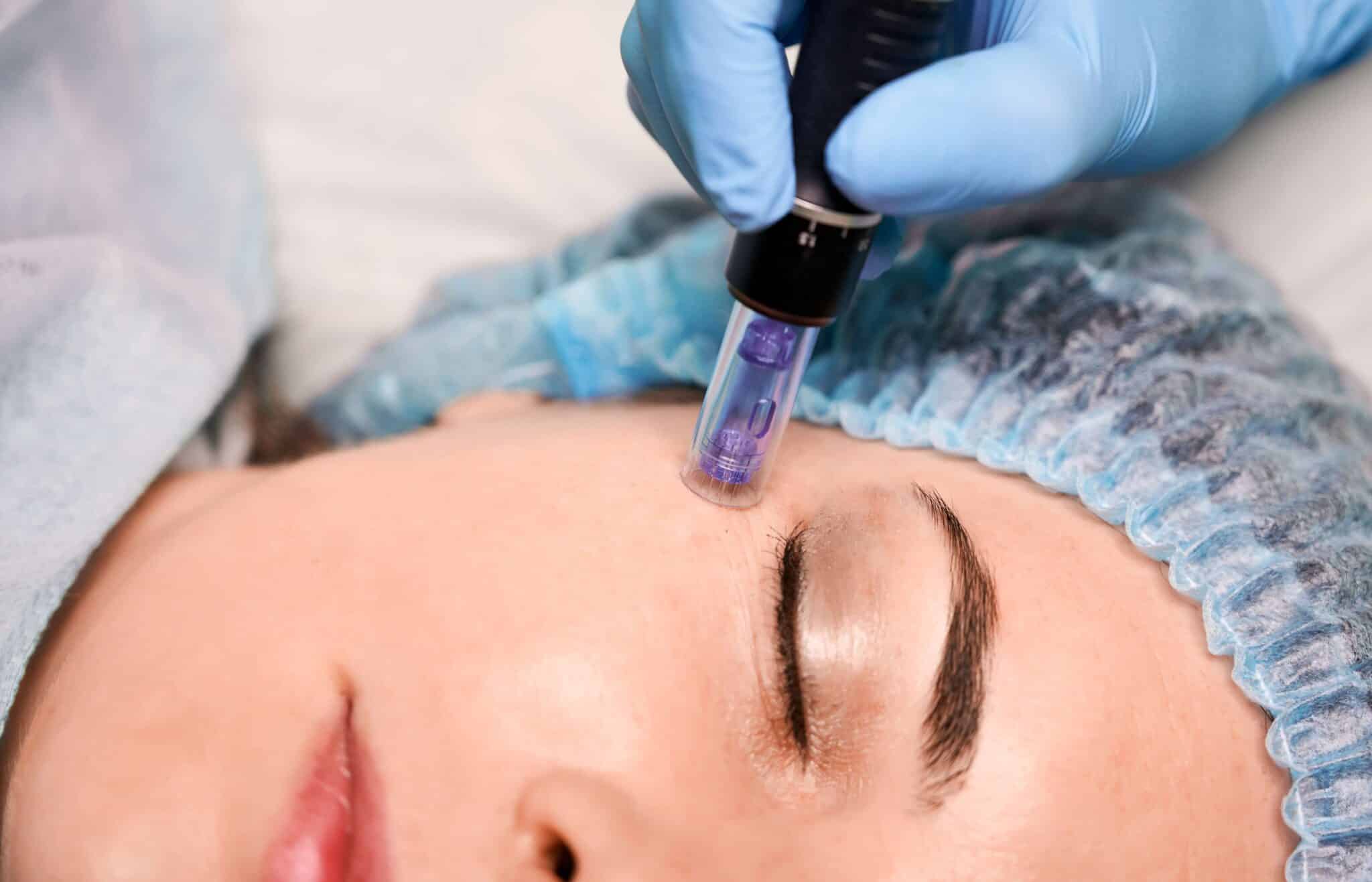 Biomicroneedling